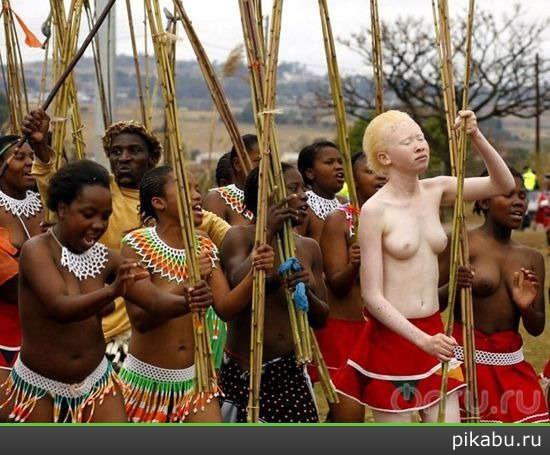 Негритянка-альбинос