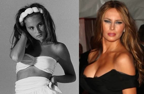 Мелания Трамп где смотреть фото до и после пластики?